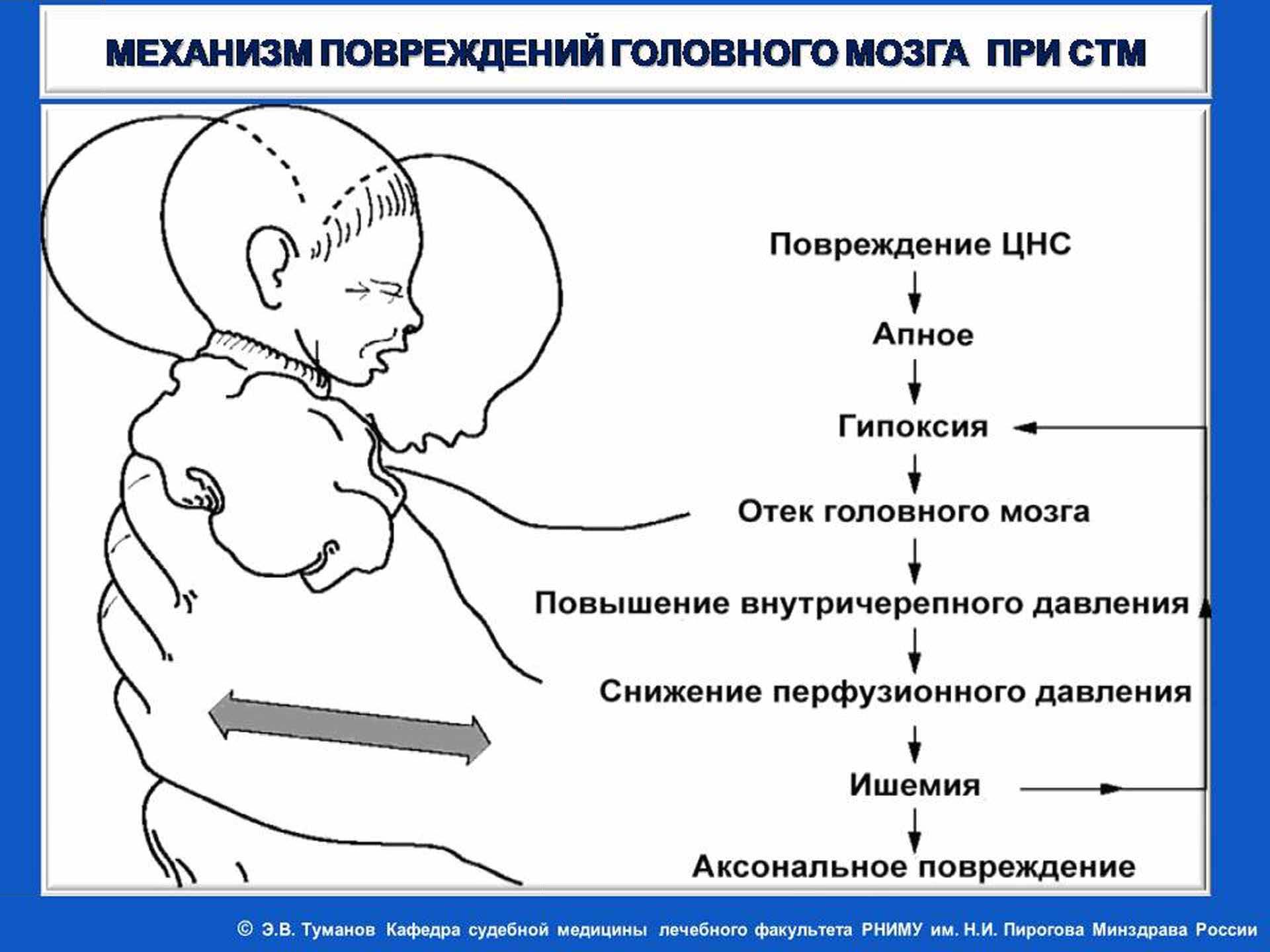 Синдром тряски у ребенка симптомы