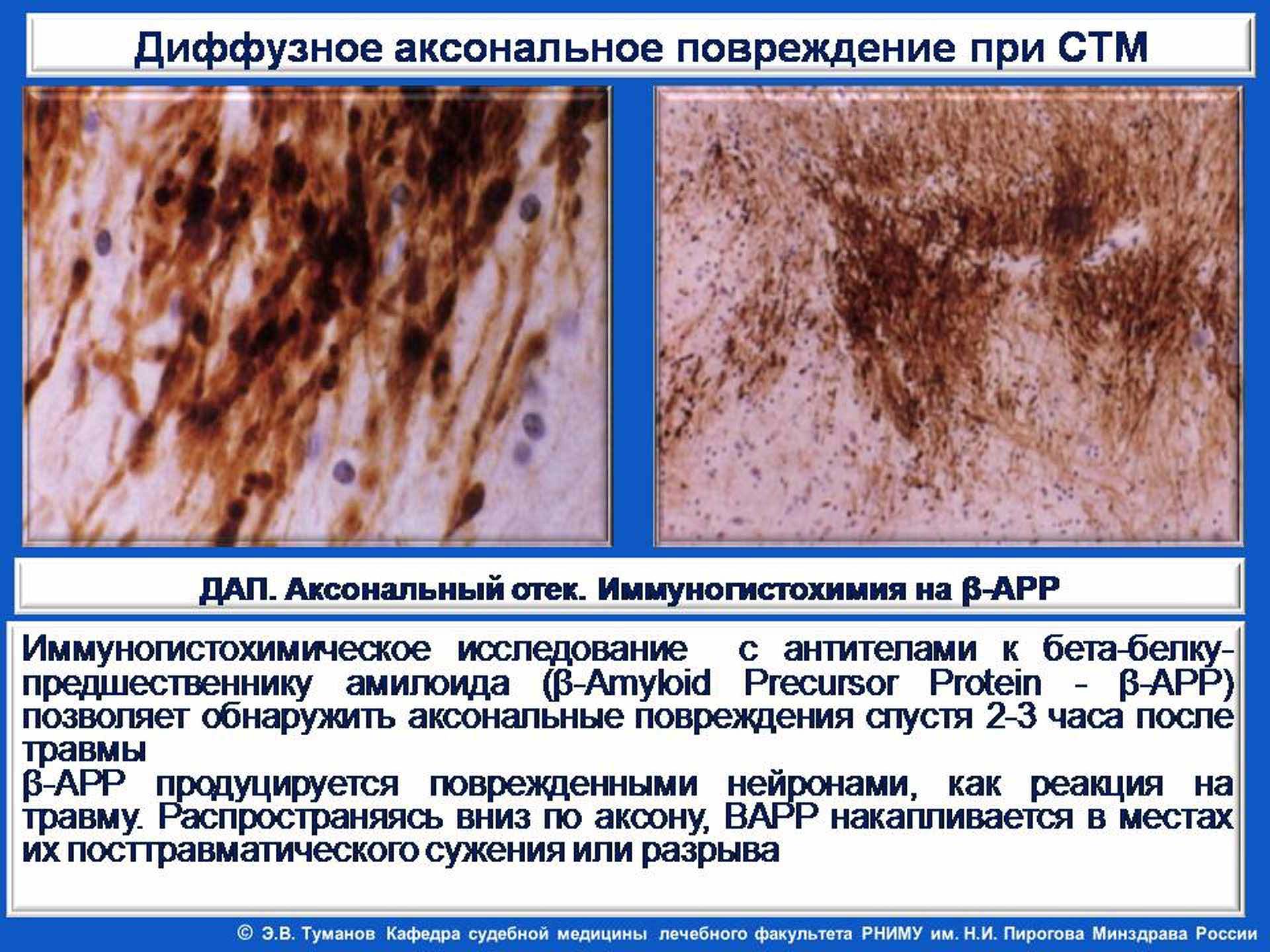 Диффузное аксональное повреждение при синдроме тряски младенца