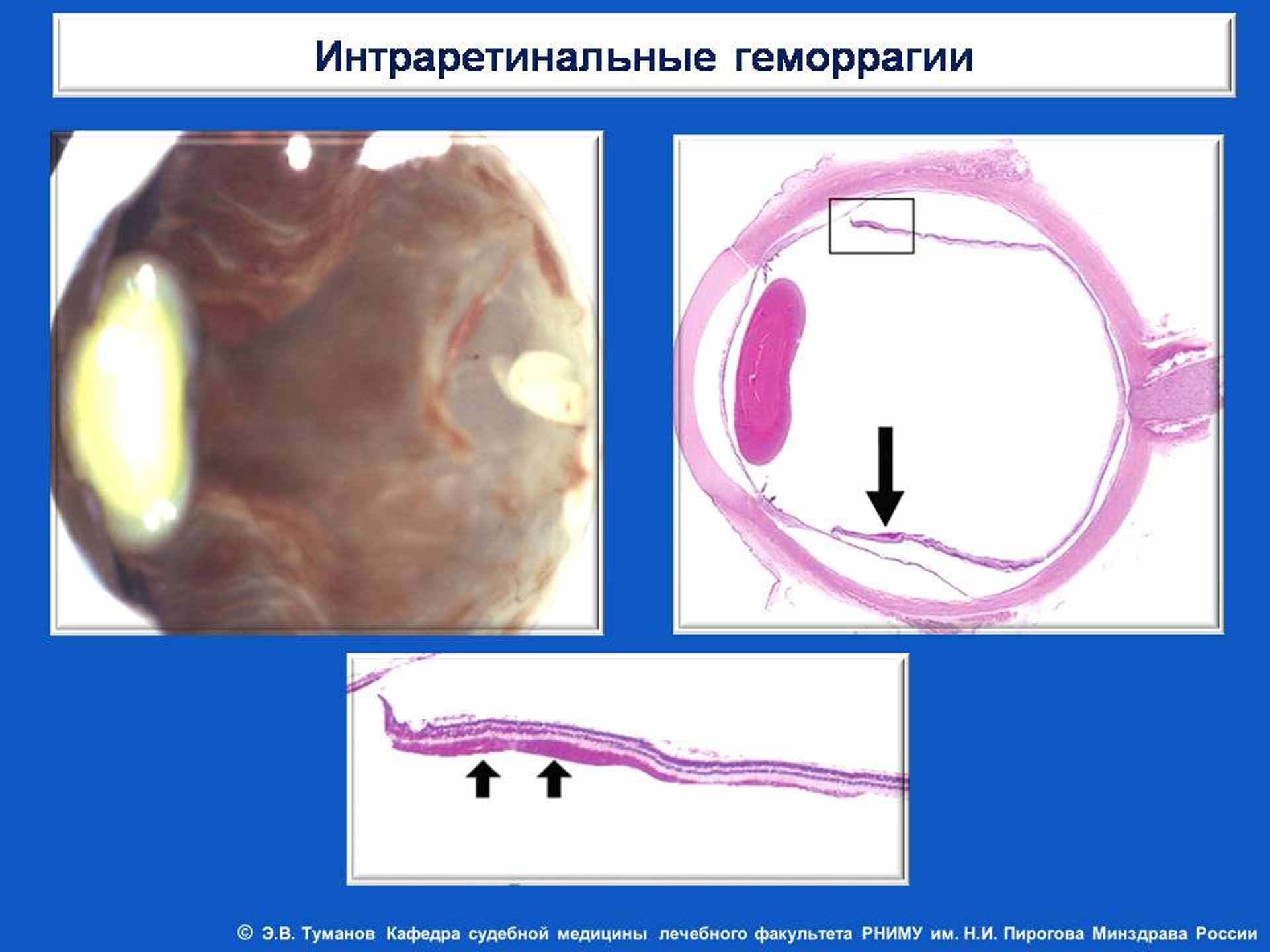 Интраретинальные геморрагии