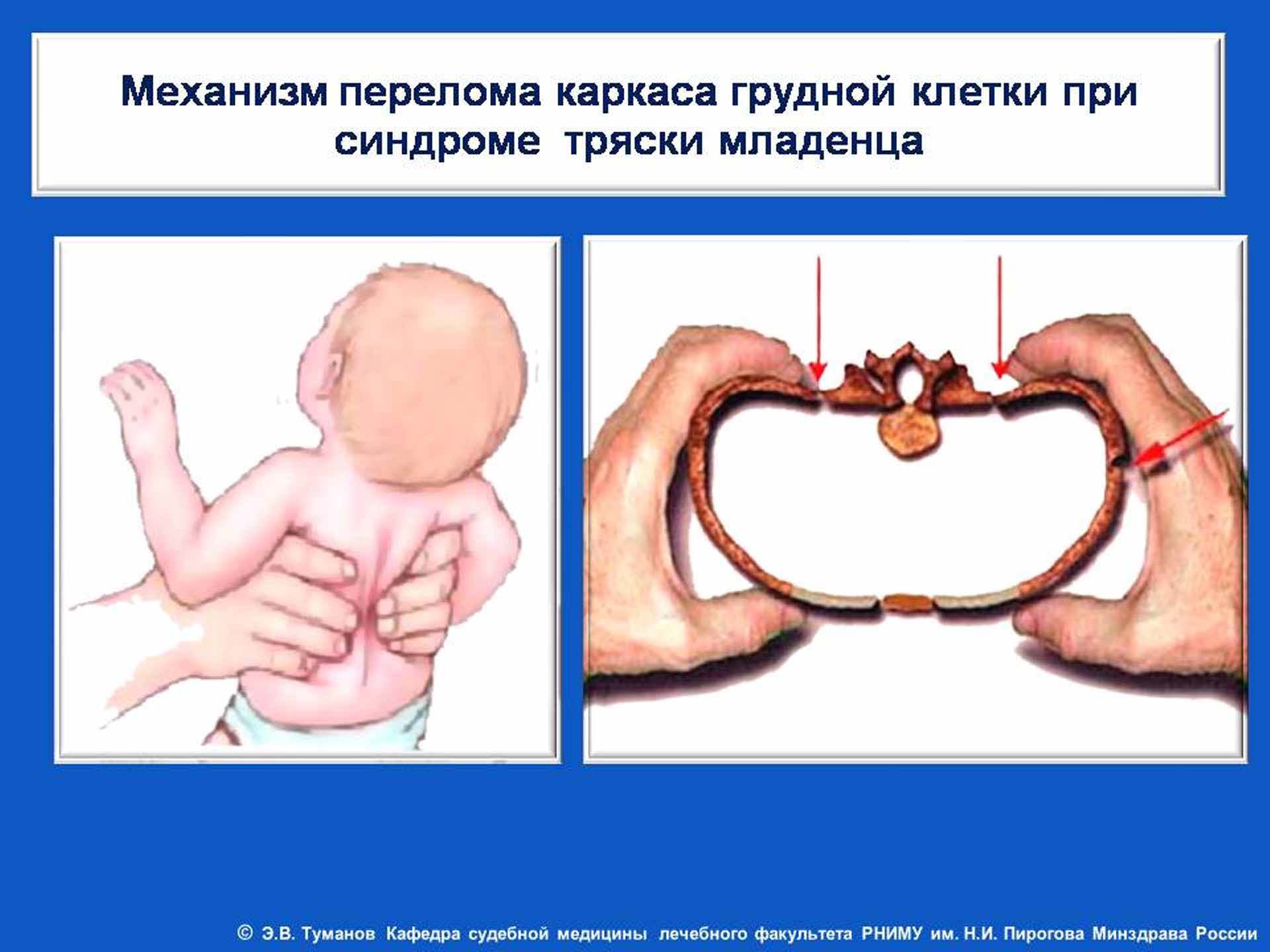 Синдром тряски у ребенка симптомы