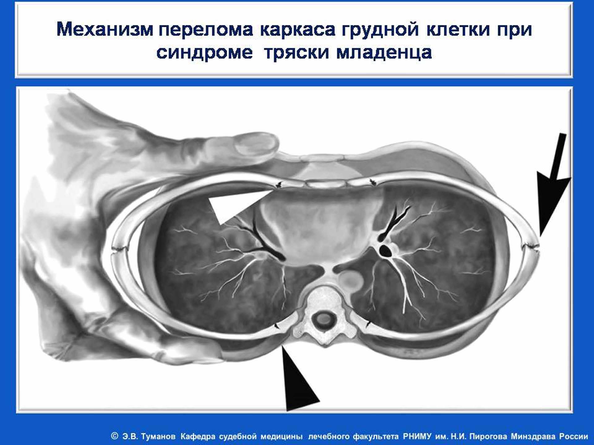 Синдром тряски у ребенка симптомы