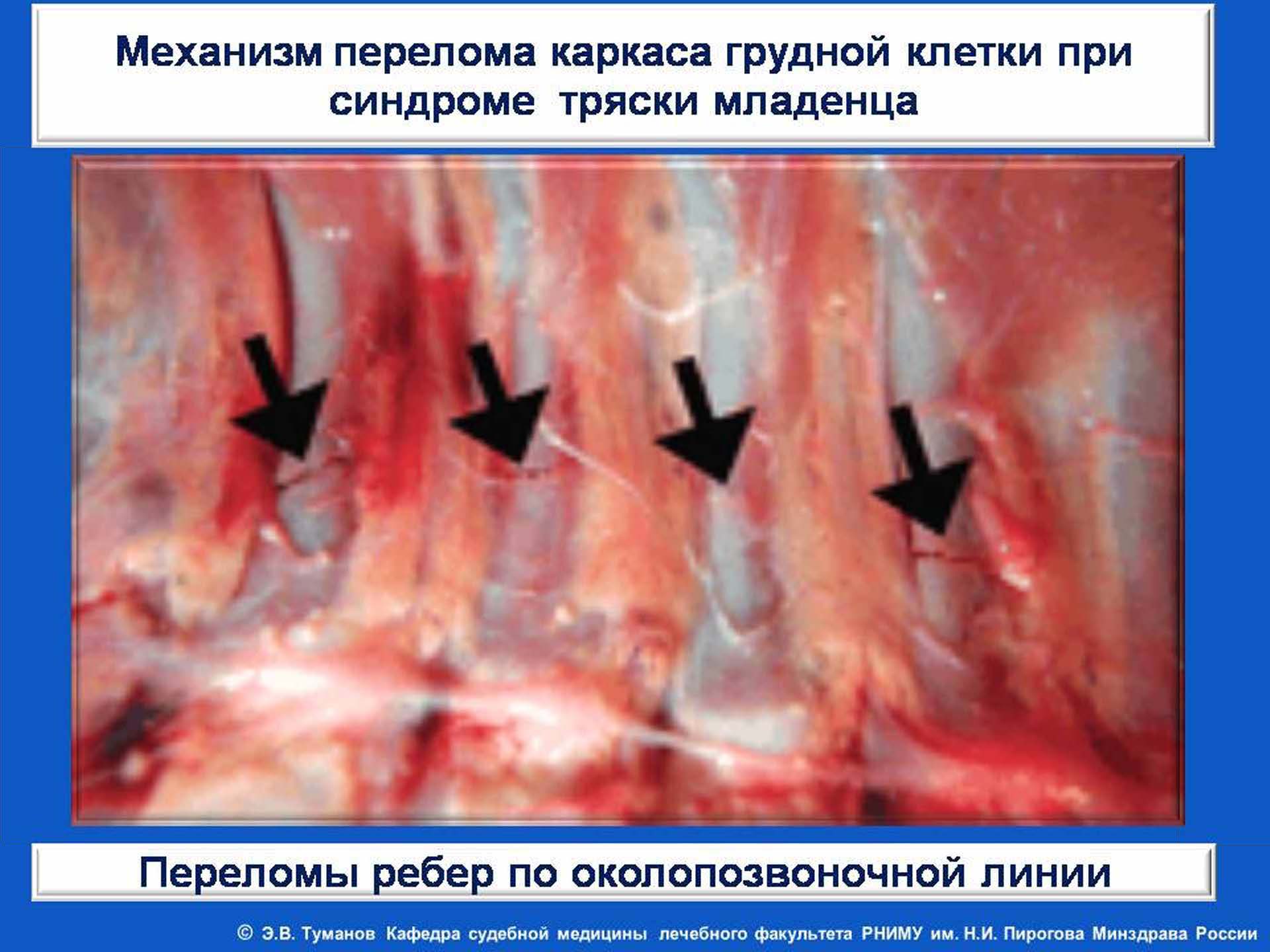 Синдром тряски у ребенка симптомы