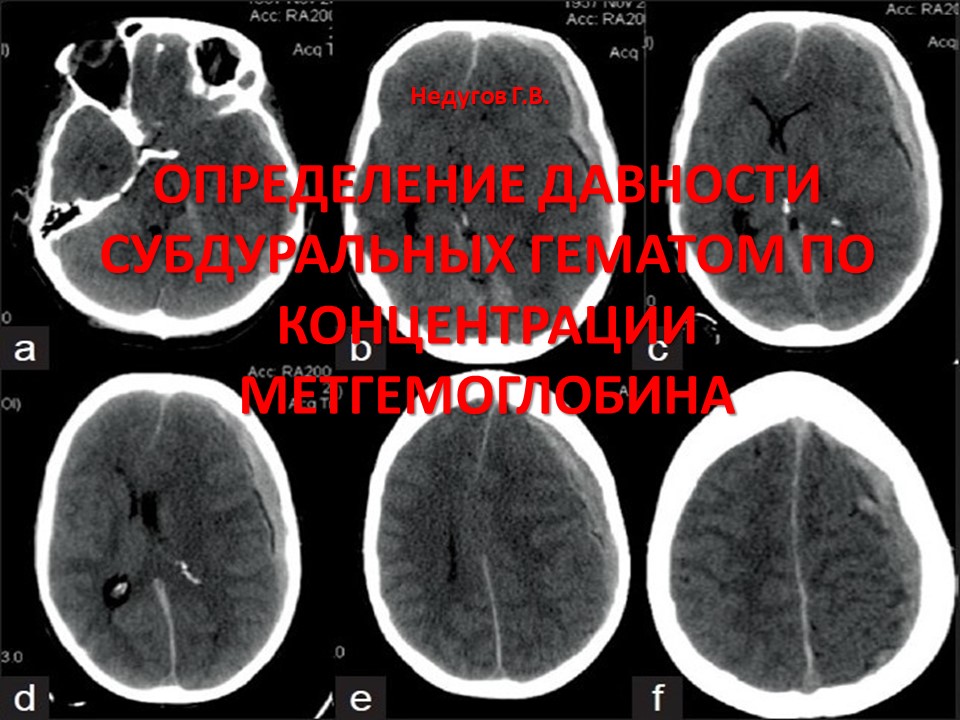 Острая субдуральная гематома клиническая картина