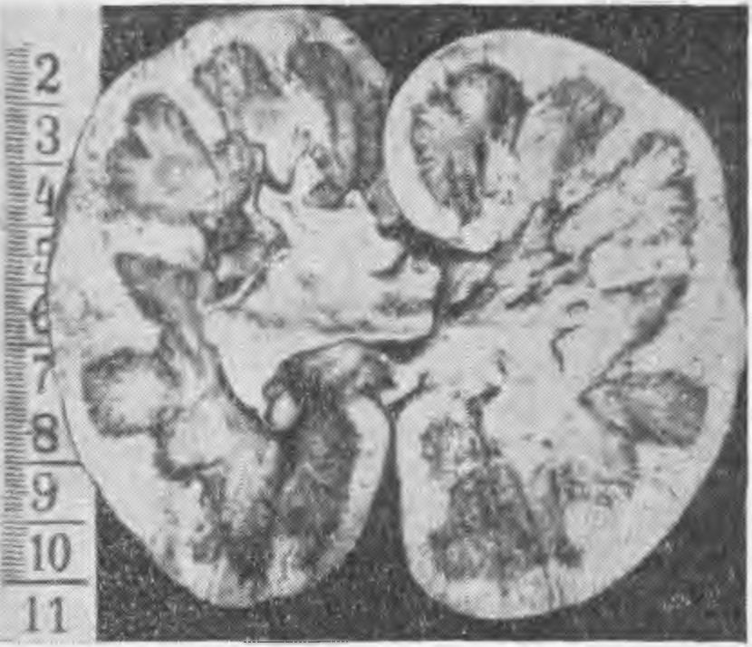 Нефроз. Гемоглобинурийный нефроз макропрепарат.